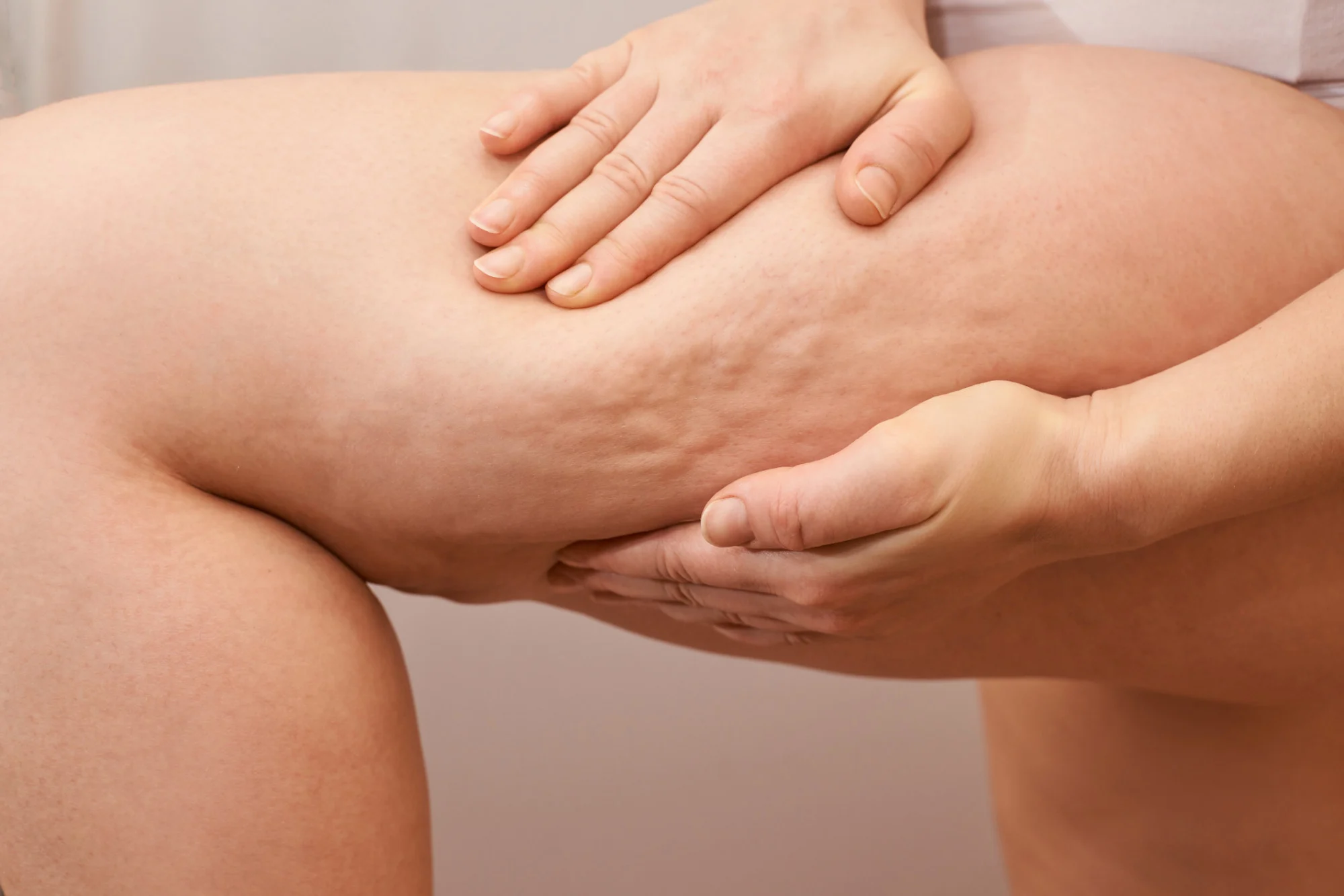 Close-up de um tratamento estético onde duas mãos massageiam a pele da coxa de uma pessoa. A pele apresenta ondulações características da celulite, e a massagem parece ser parte de um procedimento para melhorar sua aparência. A imagem enfatiza o cuidado com o corpo e técnicas de tratamento para a pele.