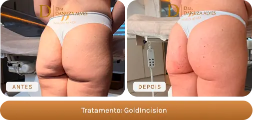 Antes e depois — GoldIncision