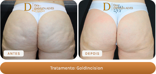 Antes e depois — GoldIncision
