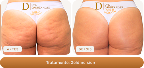 Antes e depois — GoldIncision