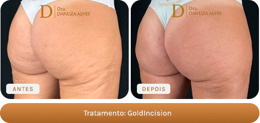 Antes e depois — GoldIncision