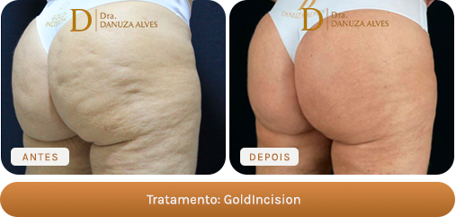 Antes e depois — GoldIncision