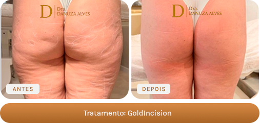 Antes e depois — GoldIncision