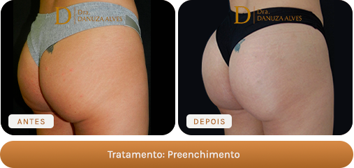 Antes e depois — Preenchimento