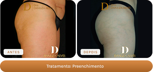 Antes e depois — Preenchimento