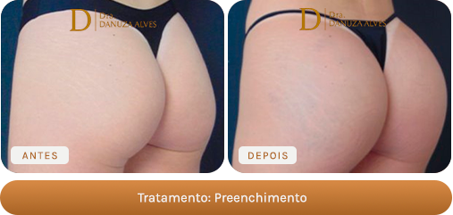 Antes e depois — Preenchimento