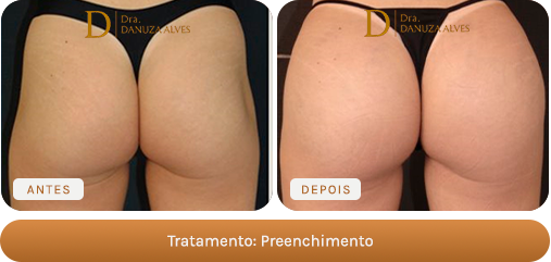 Antes e depois — Preenchimento