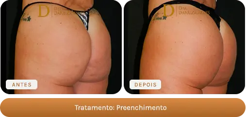 Antes e depois — Preenchimento