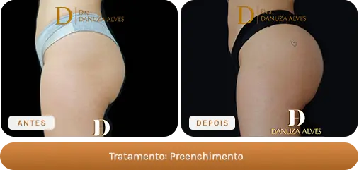 Antes e depois — Preenchimento