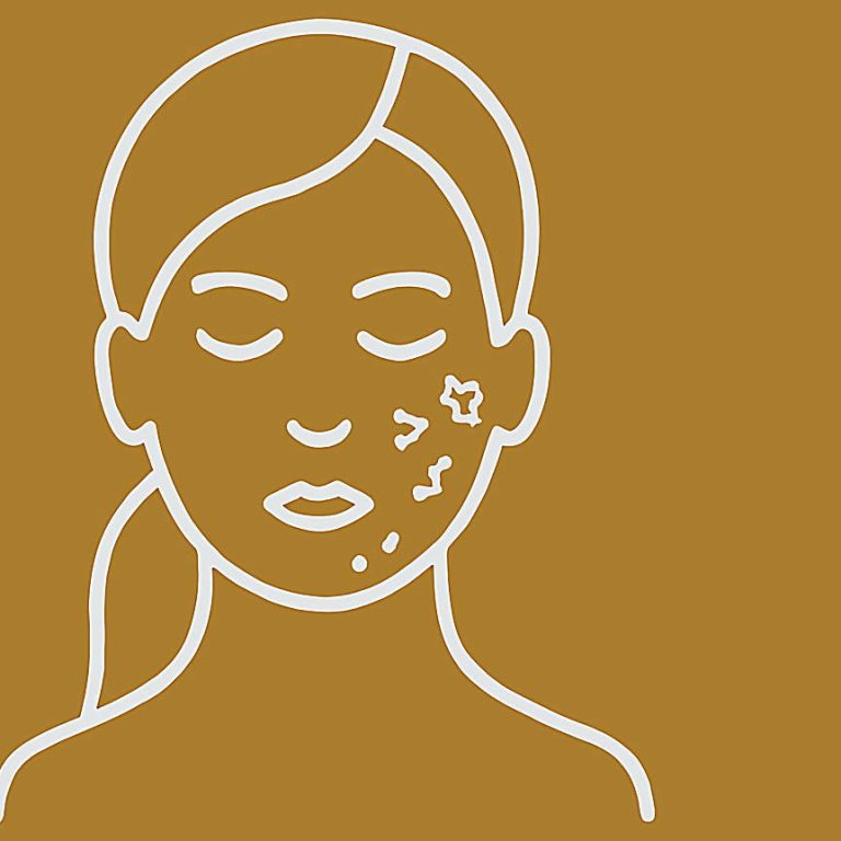 cicatrizdeacne