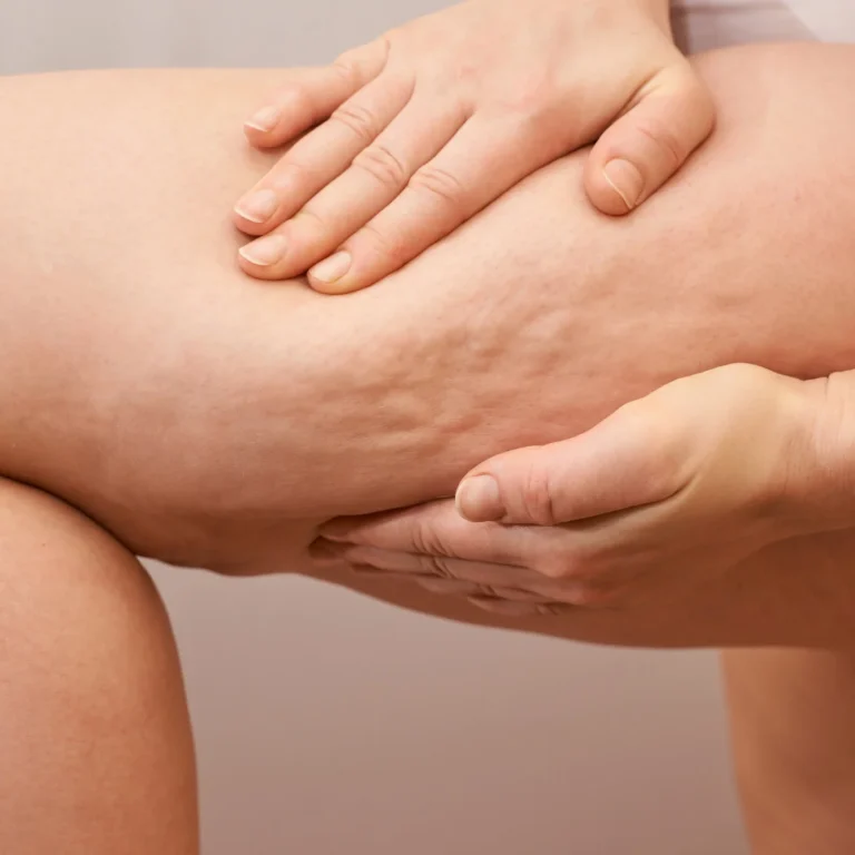 Close-up de um tratamento estético onde duas mãos massageiam a pele da coxa de uma pessoa. A pele apresenta ondulações características da celulite, e a massagem parece ser parte de um procedimento para melhorar sua aparência. A imagem enfatiza o cuidado com o corpo e técnicas de tratamento para a pele.